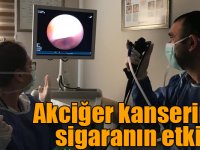 Akciğer kanserinde sigaranın etkisi