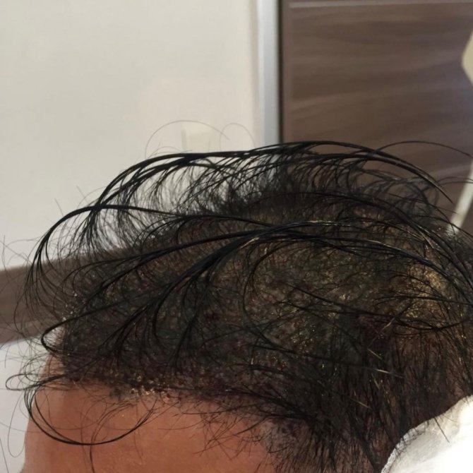 Million Hair Center CEO’su Fatih Köse: ’’Traş etmeden de saç ekim operasyonları artık günümüzde uygulanıyor’’