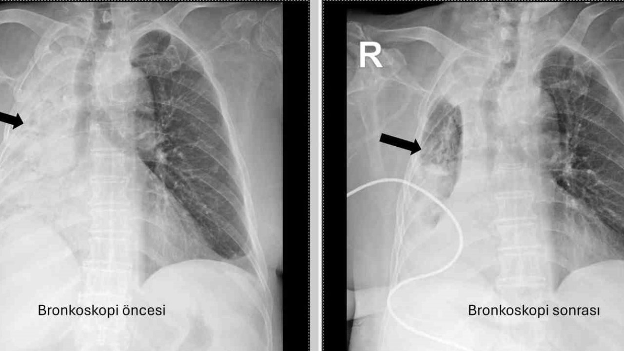 Nefes borusuna kaçan mısır tanesi 5 ay sonra ortaya çıktı