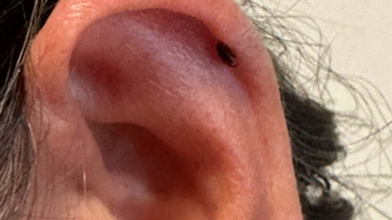 Kadının kulağını kene ısırdı