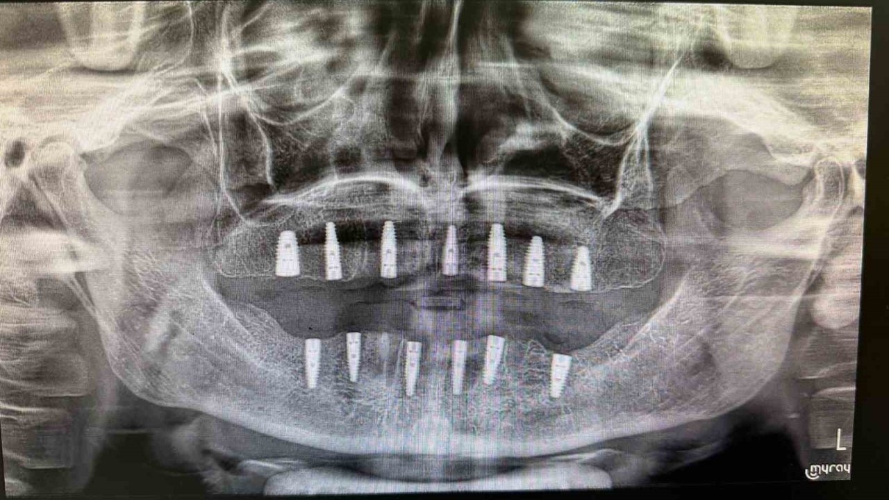Bayburt’ta hiç dişi olmayan hasta implant tedavisiyle yeni dişlerine kavuştu