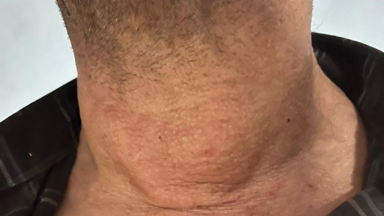 Kütahya’da dev guatr ameliyatsız tedavi edildi: Yüzde 90’dan fazla küçülme oldu