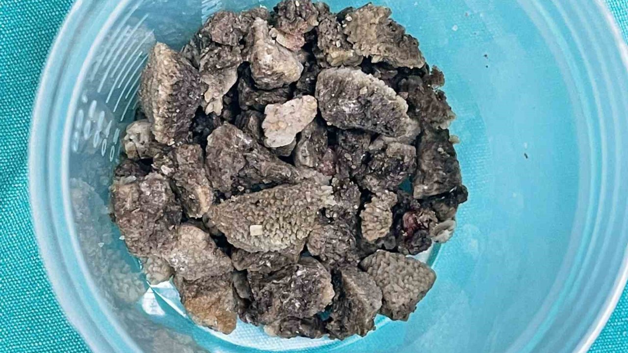 8 santimetrelik ’geyik boynuzu’ böbrek taşı kapalı yöntemle çıkarıldı