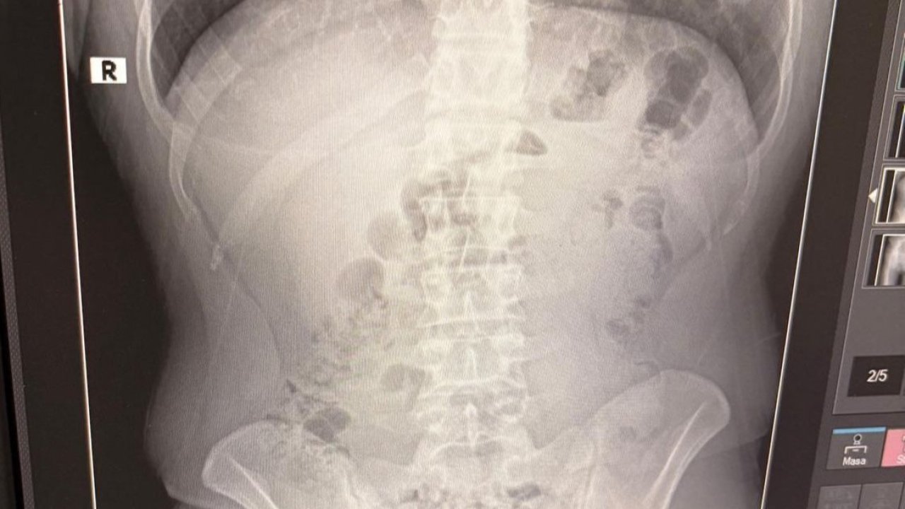 Uşak’ta midelerinden uyuşturucu çıktı: İranlı 3 kişi tutuklandı