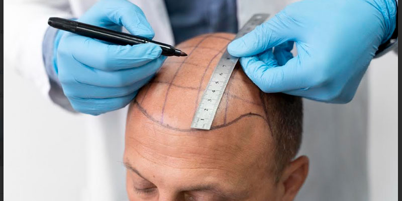 Doğal Görünümün Anahtarı: Saç Ekimi ile Kalıcı Çözümler