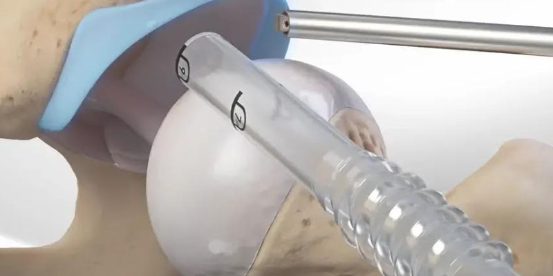 Kalça Sıkışma Sendromu: İhmal Edildiğinde Sessizce İlerleyen Bir Kalça Problemi