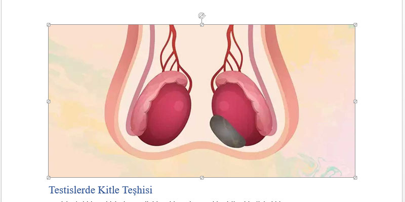 Testislerde Kitle: Belirtileri, Nedenleri ve Tedavi Yöntemleri