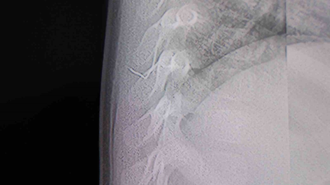 Bebeğin sırtından tel parçası çıktı