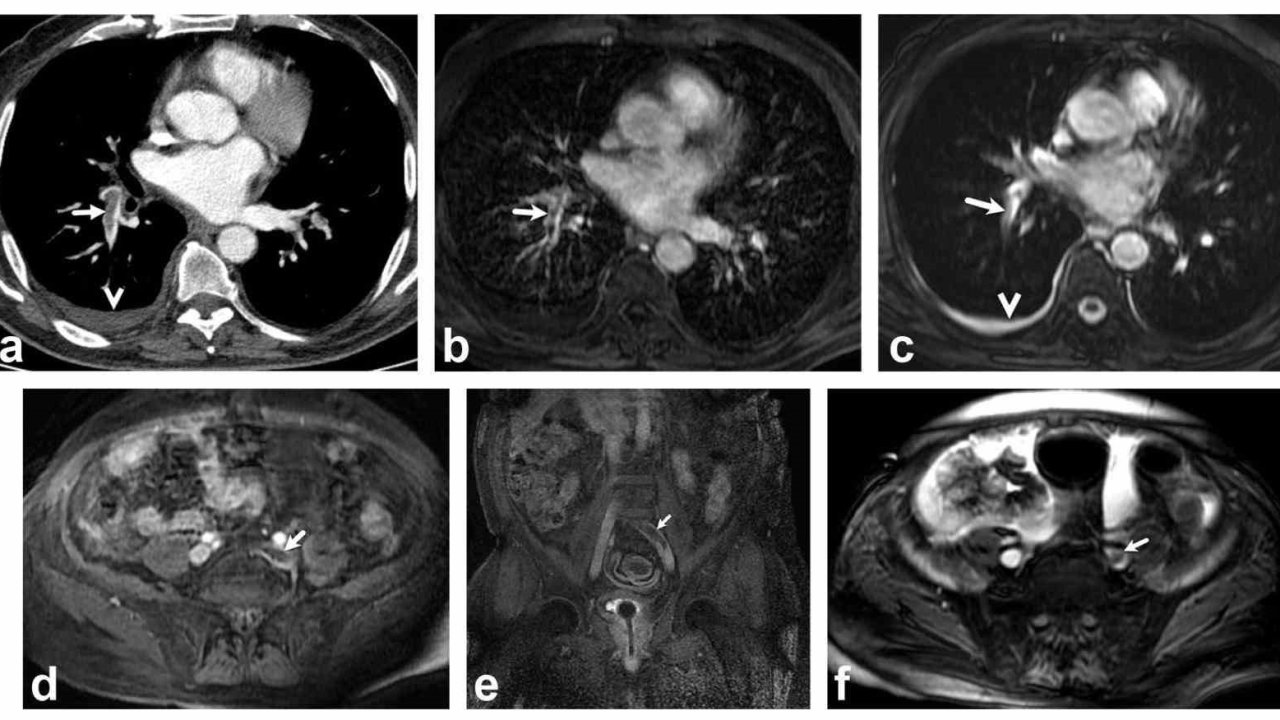 Akciğer damarındaki pıhtıların tanısında radyasyonsuz çözüm