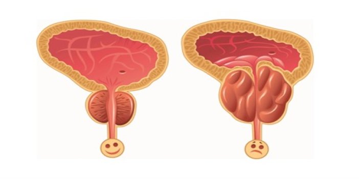 Kronik Prostatit Ankara: Ankara'da Uzman Ürologlar ve Prostatit Tedavisi