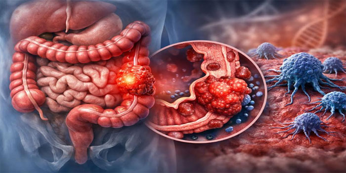 Kolon Kanseri Rehberi: Belirtiler, Nedenler, Tanı ve Tedavi Süreci