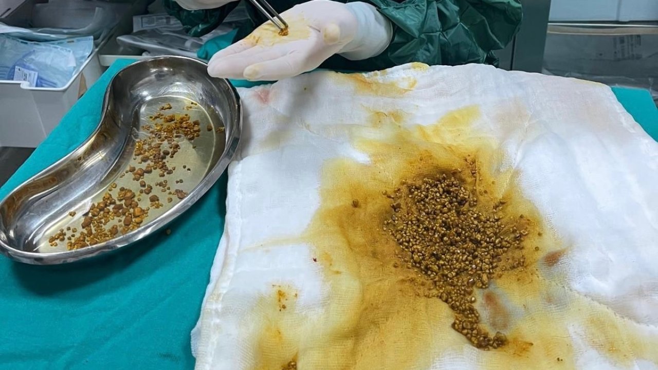 Bingöl’de nadir vaka: Safra kesesinden 2 bin 67 taş çıkarıldı