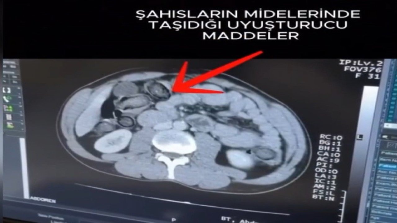 Mideye gizlenen uyuşturucu Erzincan’da ele geçirildi