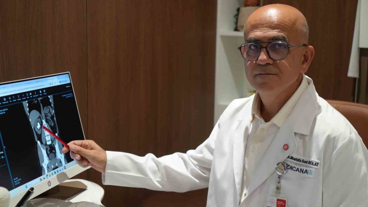 25 cm küplük böbrek taşı, hastanın sırtından girilerek çıkartıldı