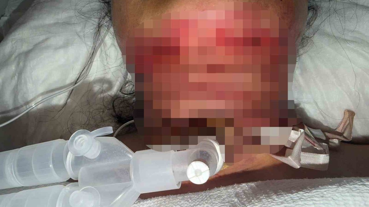 Gıdı estetiği sonrası nefes alamadı, boynundan acil solunum yolu açıldı