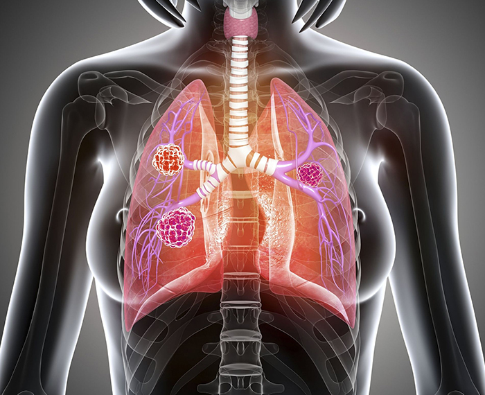 Akciğer Kanseri Ameliyat Yöntemleri: