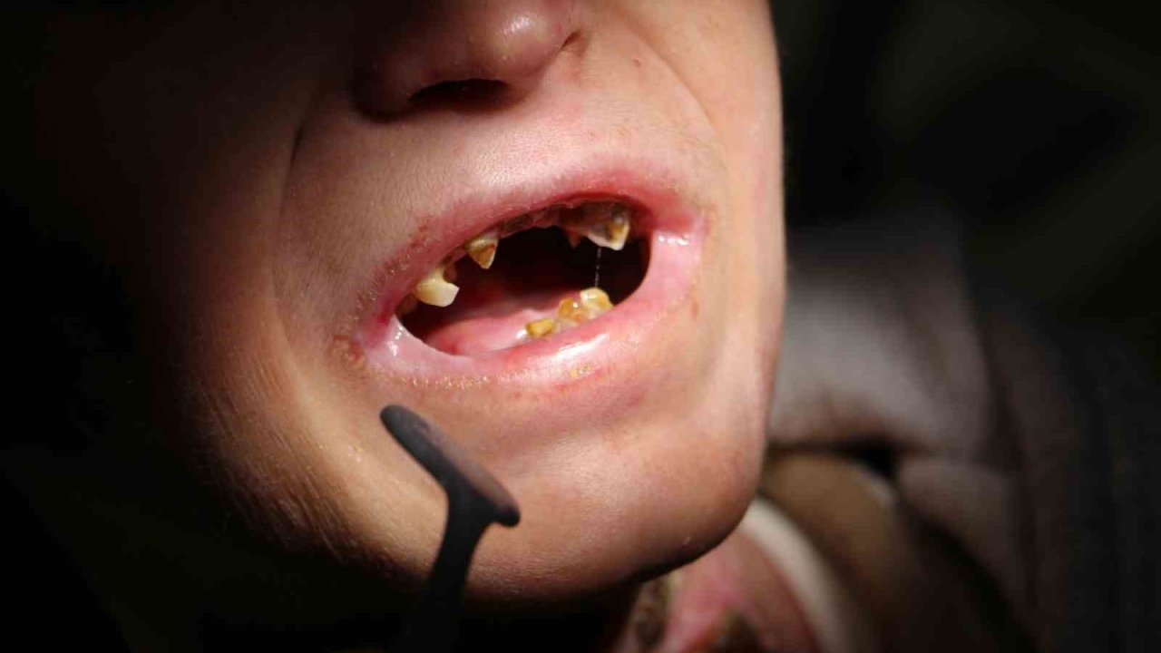 Diyarbakır’da kelebek hastası 18 çocuğun diş tedavisi yapıldı