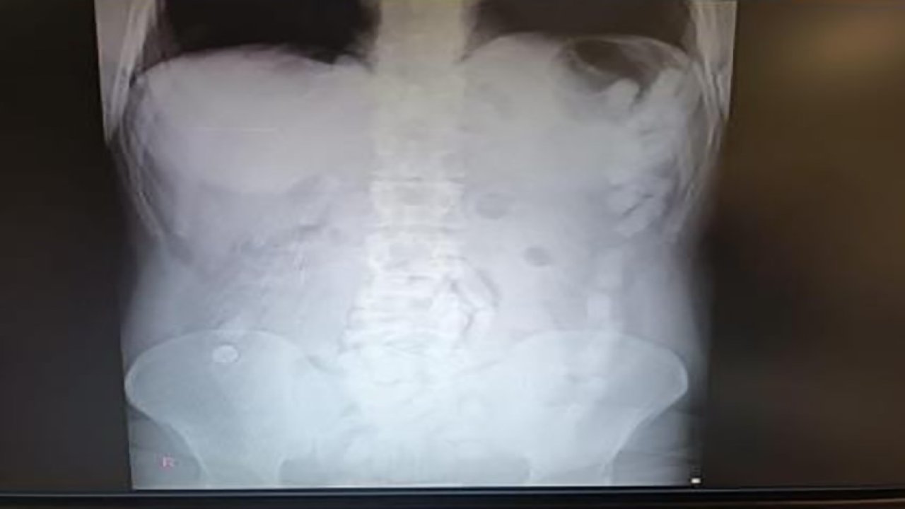 Midesinde uyuşturucu maddeyle yakalanan şahsa 12 yıl hapis cezası