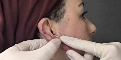 Muş’ta bir ilk: Kulak keloidi, ödüllü cerrahi teknikle tedavi edildi