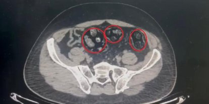 Yolcunun midesinden 62 parça uyuşturucu çıktı