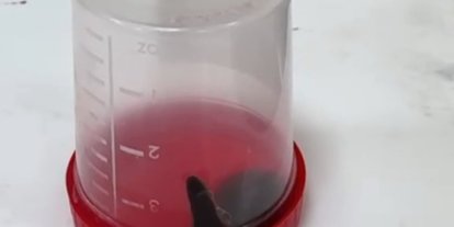 Siirt te 6 yaşındaki çocuğun boğazından sülük çıktı