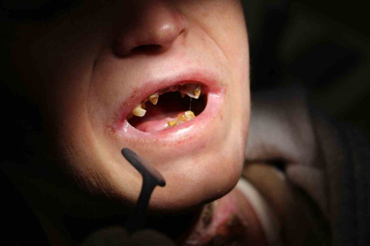 Diyarbakır’da kelebek hastası 18 çocuğun diş tedavisi yapıldı