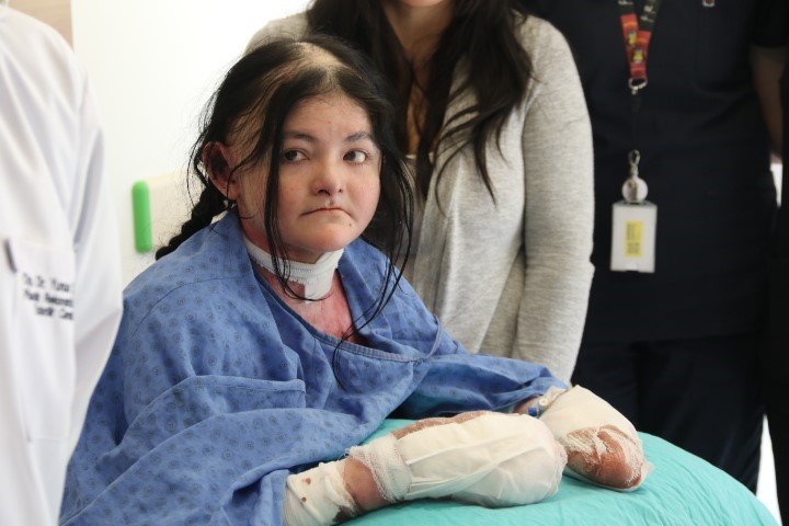 Amerikalı Ledesa’nın parmakları evinden 9 bin 930 kilometre ötedeki Eskişehir’de açıldı