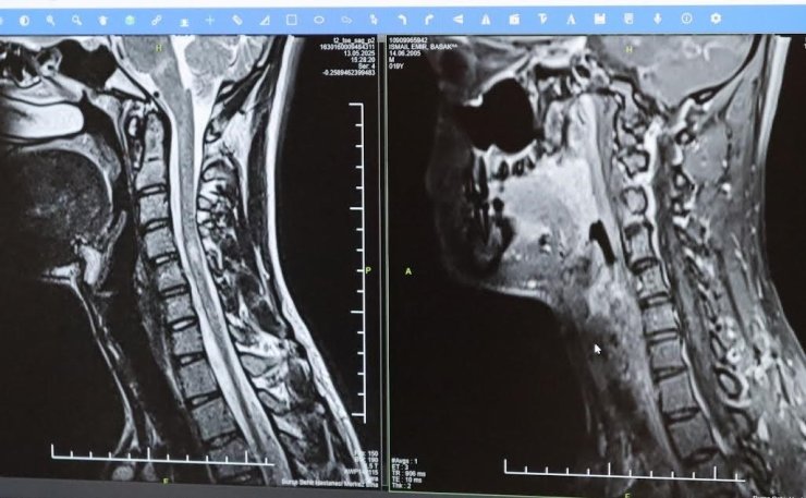 MS hastalığında erken teşhis hayat kalitesini arttırıyor