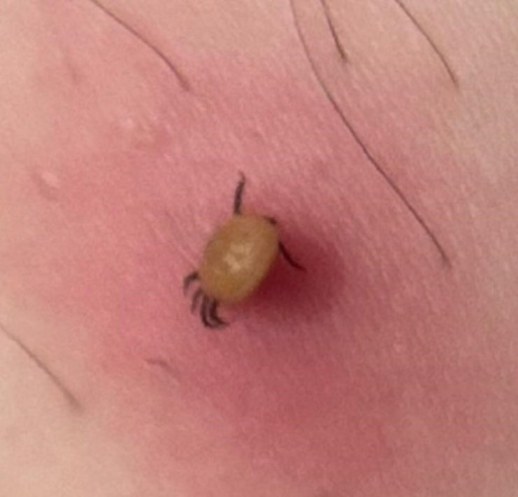 "Kene ısırığı belirtisiz başlar, hızla ağırlaşabilir"