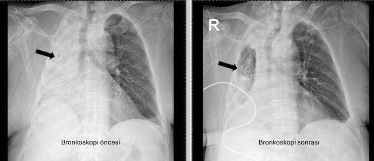 Nefes borusuna kaçan mısır tanesi 5 ay sonra ortaya çıktı