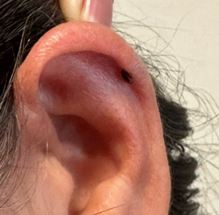 Kadının kulağını kene ısırdı