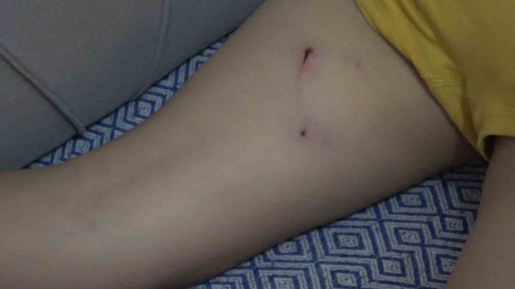 Rize’de 5 yaşındaki çocuk, sokak köpeğinin saldırısına uğradı