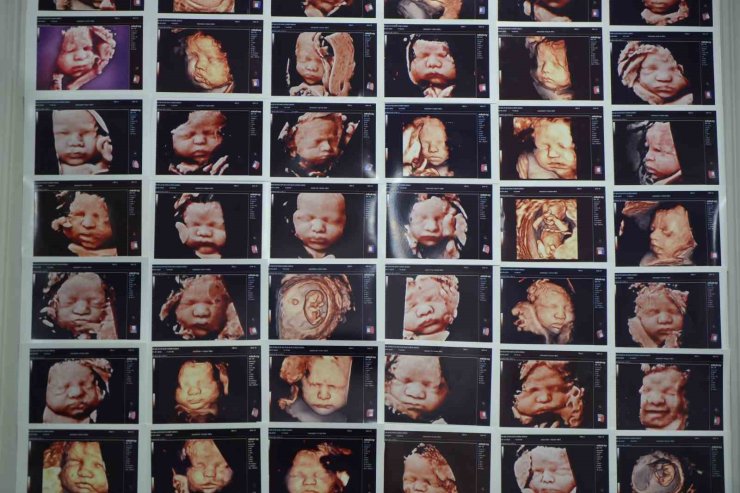 7 yıllık bebek hasreti "kişiye özel" tedaviyle son buldu